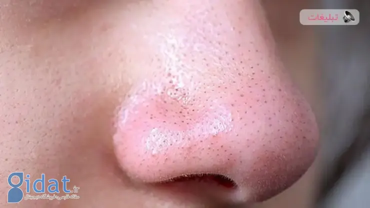 چرا پوست صورت بعد از جراحی بینی چرب می شود؟