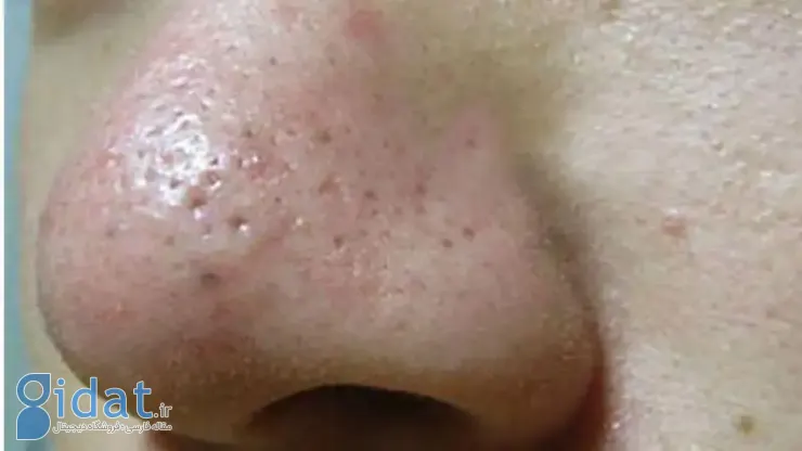 پیشگیری از چرب شدن پوست بعد از عمل
