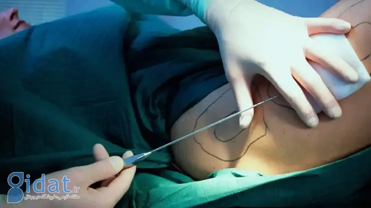 9 روش جراحی و غیر جراحی برتر برای رسیدن به اندام ایده‌آل