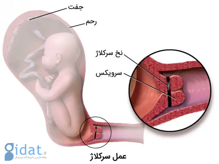 سرویکال سرکلاج