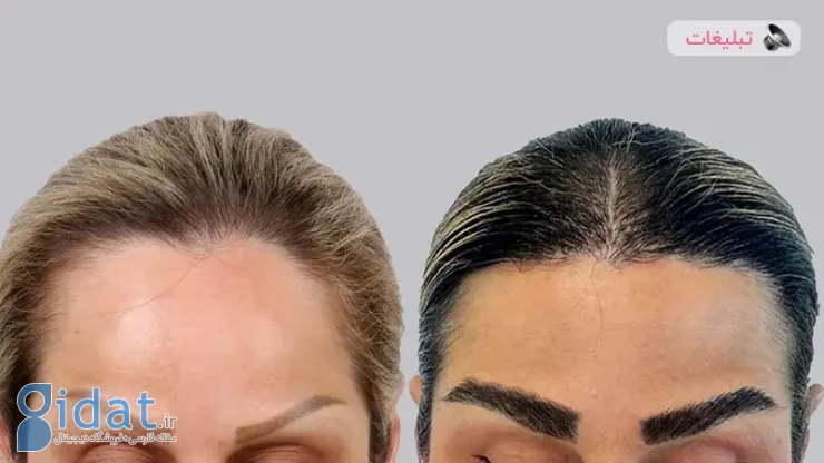 کاشت ابرو با جدیدترین متدهای روز دنیا
