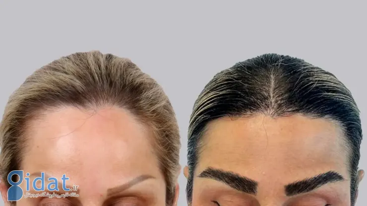 جدیدترین روش کاشت ابرو 