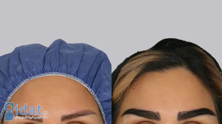 مراحل کاشت ابرو به روش FUE