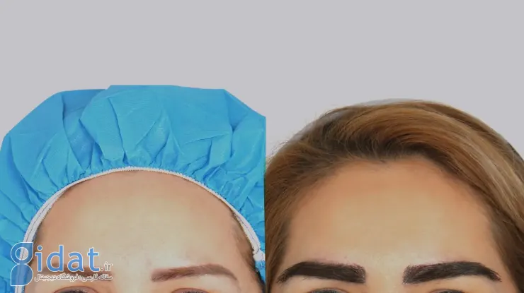 مزایا استفاده از روش fue برای کاشت ابرو