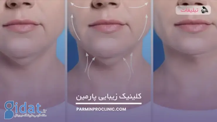 ساکشن دو چانه بدون جراحی، سریعترین راه برای از بین بردن دو چانه | بررسی هزینه ساکشن دوچانه در تهران در سال 1404