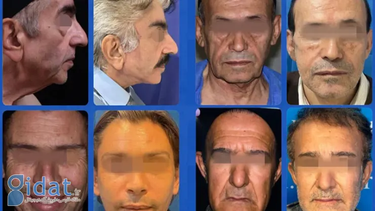 نمونه عمل لیفت صورت