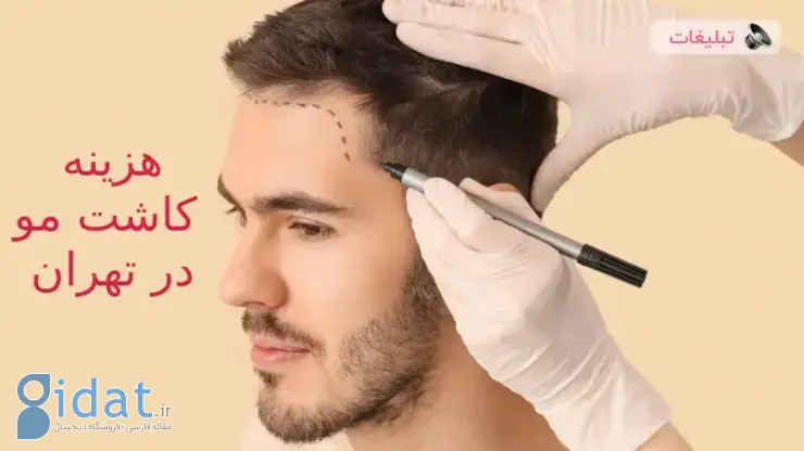 هزینه کاشت مو در بهترین کلینیک های تهران چقدر است؟ &؛amp؛#x2B؛ بررسی کامل