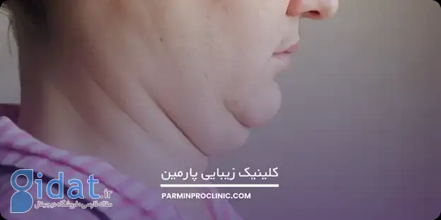 آنچه که باید بیشتر در مورد ساکشن غبغب بدانید