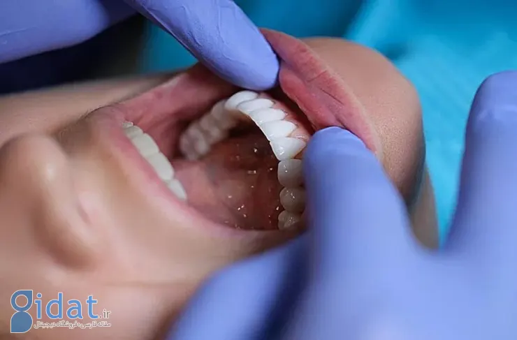 مطالعه جدید: بیماری لثه ممکن است خطر سکته مغزی را افزایش دهد