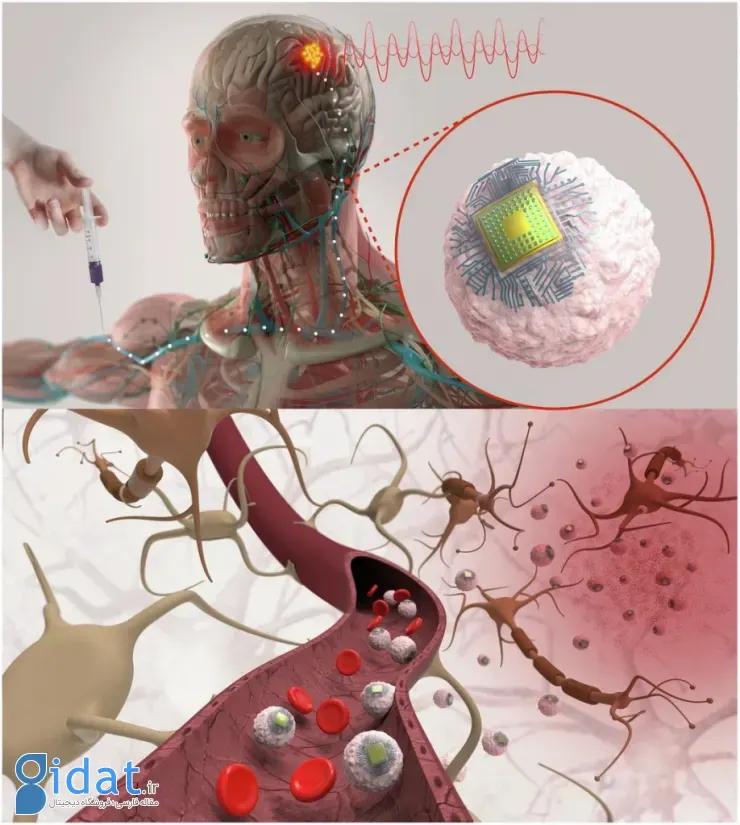 درمان بیماریهای مغزی با تراشههای تزریقی