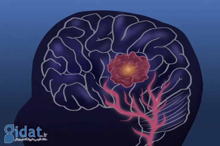 درمان جدید سرطان، اندازه یک تومور مغزی کشنده را در عرض چند روز کاهش داد