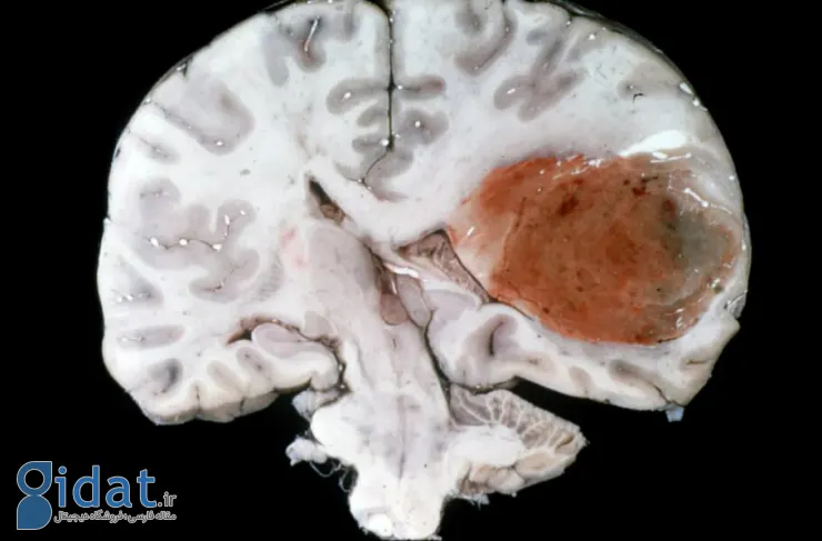یک درمان جدید سرطان در عرض چند روز اندازه تومور مرگبار مغز را کاهش داد