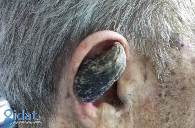 شاخ انسان چیست و چرا در برخی افراد رشد می‌کند؟