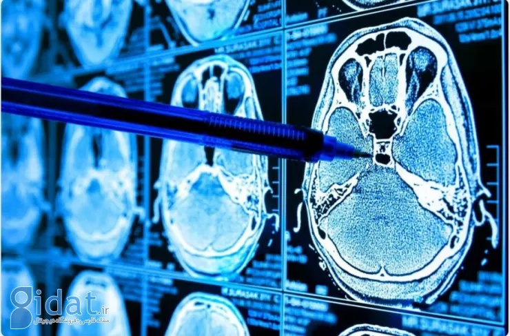 توسعه هوش مصنوعی جدید که می تواند علائم بیماری را در اسکن MRI پیدا کند