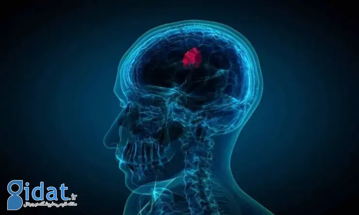 گلیوبلاستوما 