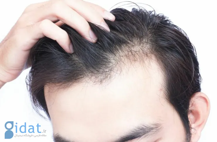 پیشرفت محققان: توقف ریزش مو با مسدود کردن یک مکانیسم بیولوژیکی قدیمی