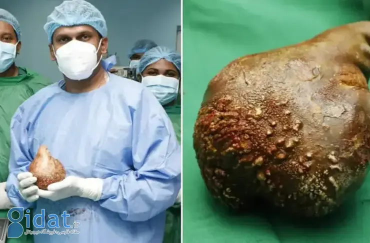 بزرگترین و سنگین ترین سنگ کلیه جهان با موفقیت از بدن یک بیمار خارج شد