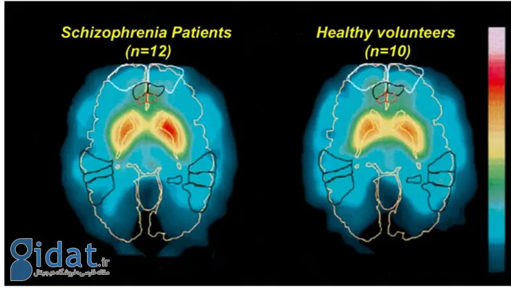 تشخیص دقیق اسکیزوفرنی با هوش مصنوعی BrainProbe در تایوان