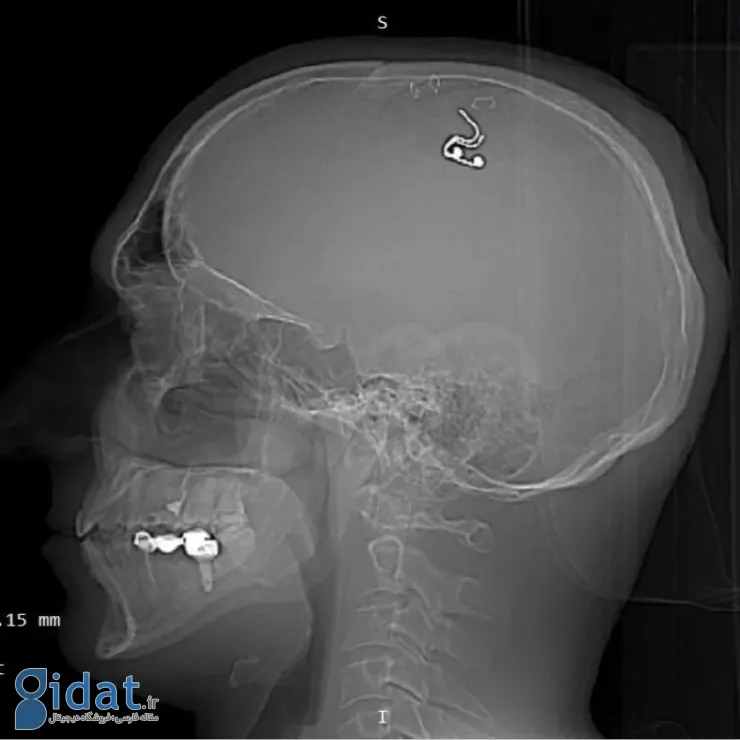 کنترل رؤیاها با ایمپلنت مغزی؛ یک محقق روسی با دریل مغزش را سوراخ کرد و در آن تراشه کاشت!