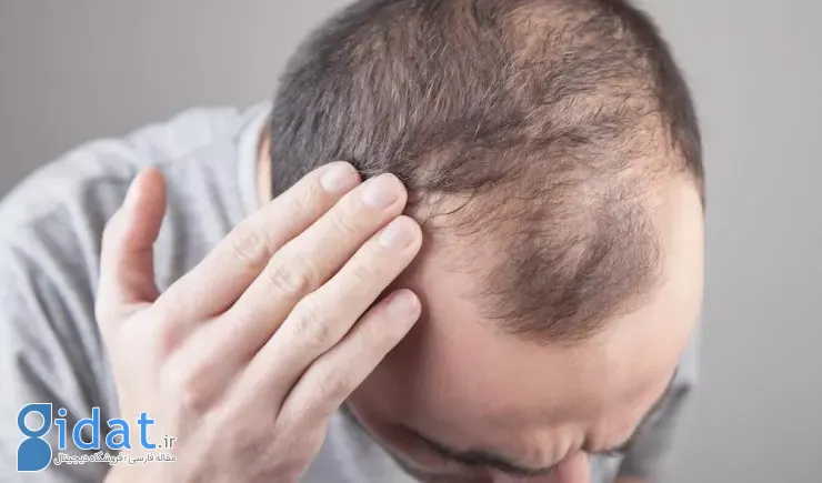 ریزش مو در اثر استرس