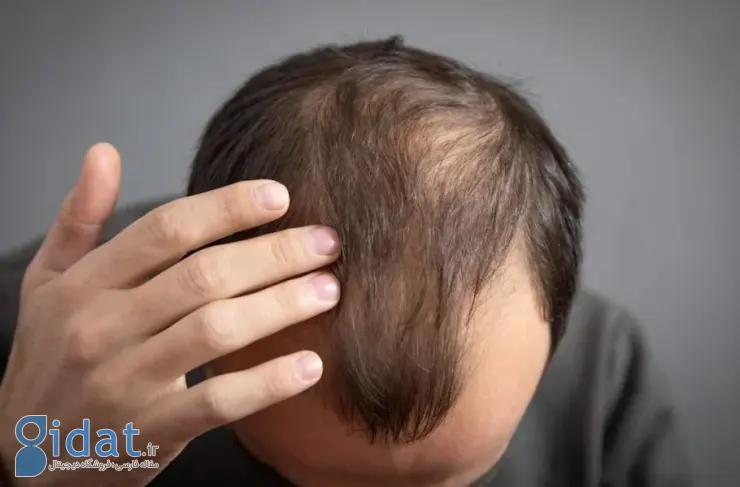 دستاورد دانشمندان تایوانی: درمان ریزش مو در ۲۰ روز با یک سرم ساده