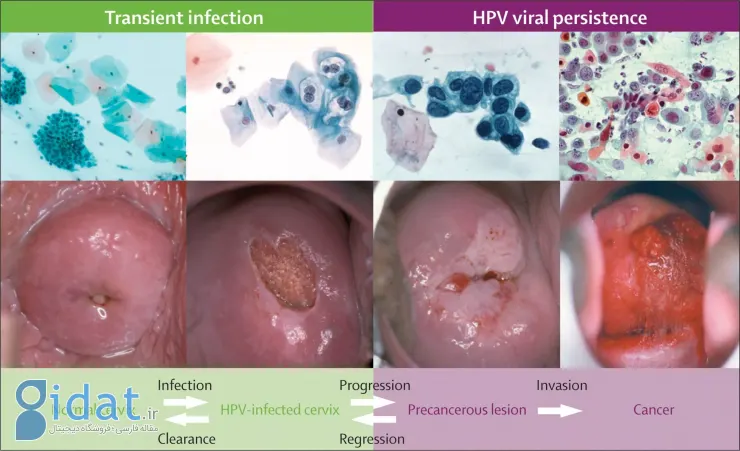 هرآنچه باید درباره اچ‌پی‌وی (HPV) بدانید