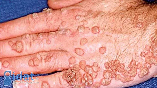 هرآنچه باید درباره اچ‌پی‌وی (HPV) بدانید