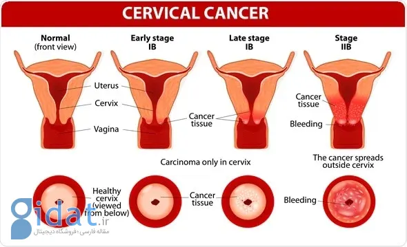 هرآنچه باید درباره اچ‌پی‌وی (HPV) بدانید