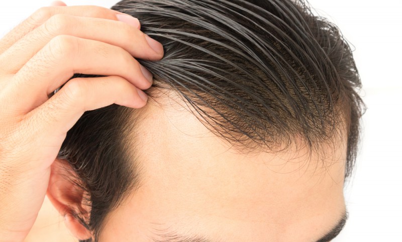 کدام کلینیک برای کاشت مو به روش FUT در تهران مناسب‌تر است؟