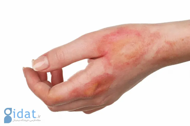 ترمیم اسکار قدیمی با سلول های بنیادی چگونه انجام می شود؟ + مزایا و عملکرد