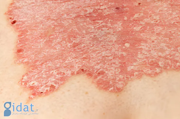 استفاده از سلول های بنیادی در ترمیم زخم