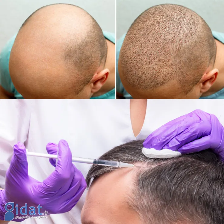 روش انجام پی آر پی بعد از کاشت مو