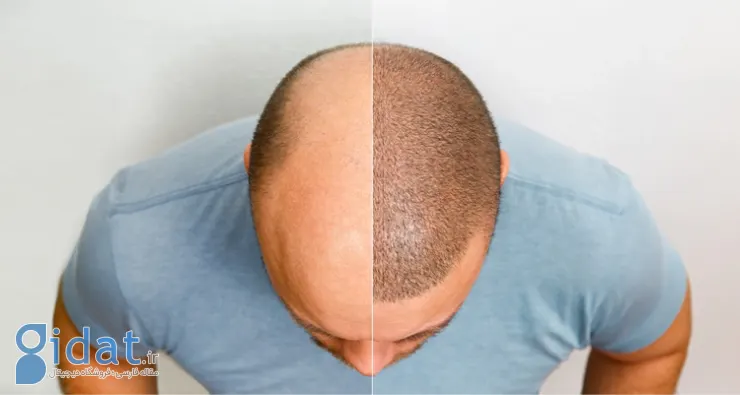 مزایای پی آر پی بعد از کاشت مو چیست؟