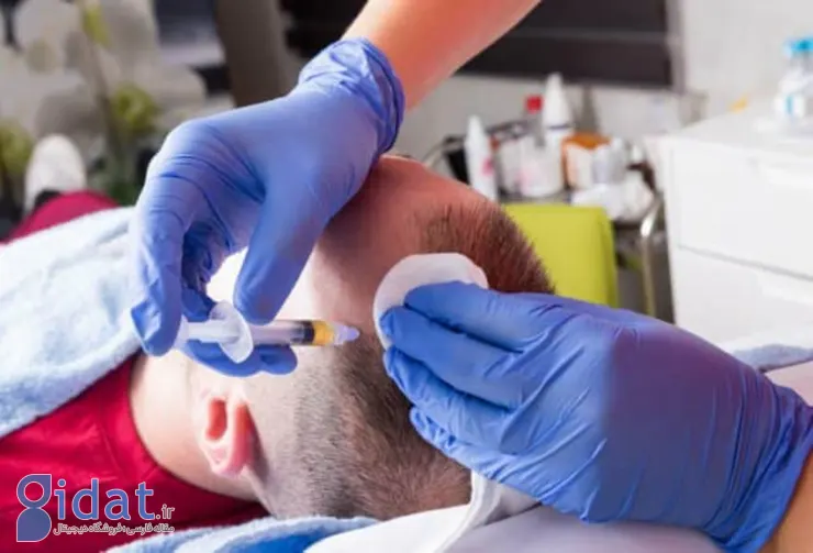 تاثیرات پی آر پی پس از کاشت مو