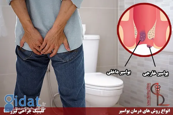 درمان بیماری های صندلی با لیزر و جراحی – کلینیک شفا