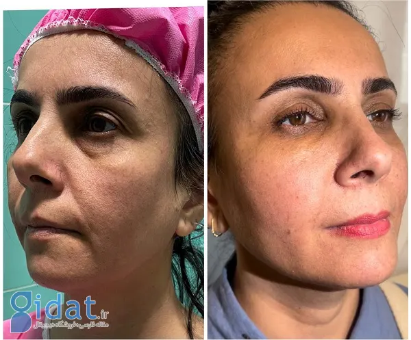 جوانسازی صورت به روش نوراژنزیس یک روش ترکیبی با نتایج طولانی مدت