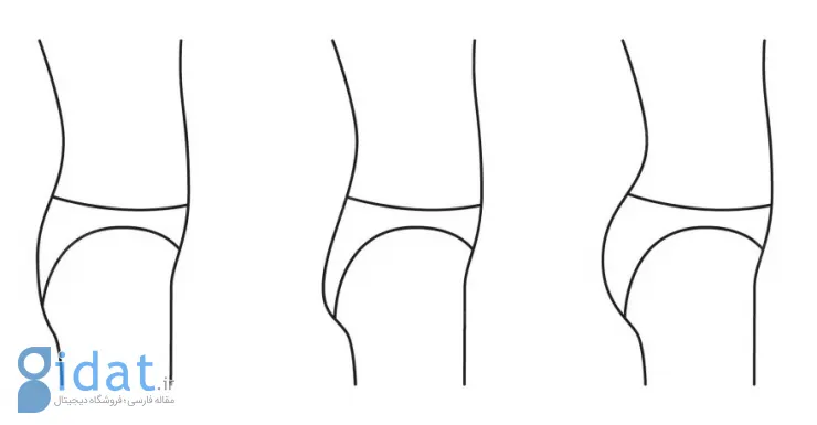 تزریق فیلر به باسن چگونه است؟