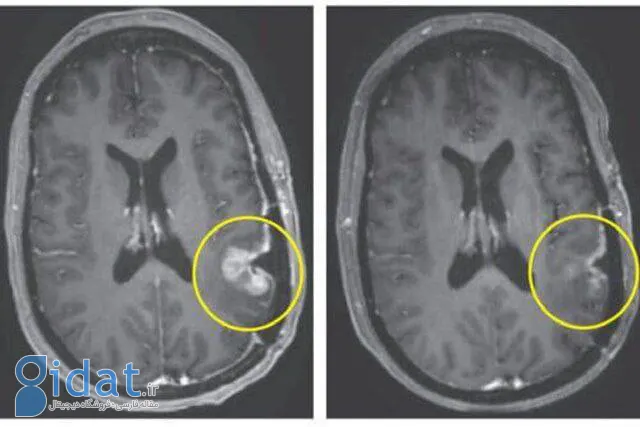 درمان باورنکردنی تومور مغز تنها در 5 روز!