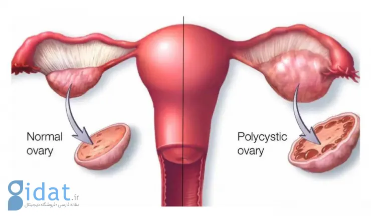 کیست تخمدان چیست، چند نوع دارد و چگونه درمان می شود؟