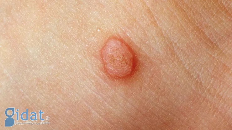 هزینه برداشتن یک خال در سال ۱۴۰۴ چقدر است؟