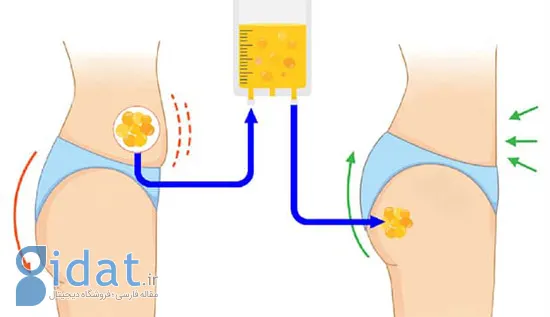 هزینه تزریق چربی به باسن در سال ۱۴۰۴ چقدر است؟