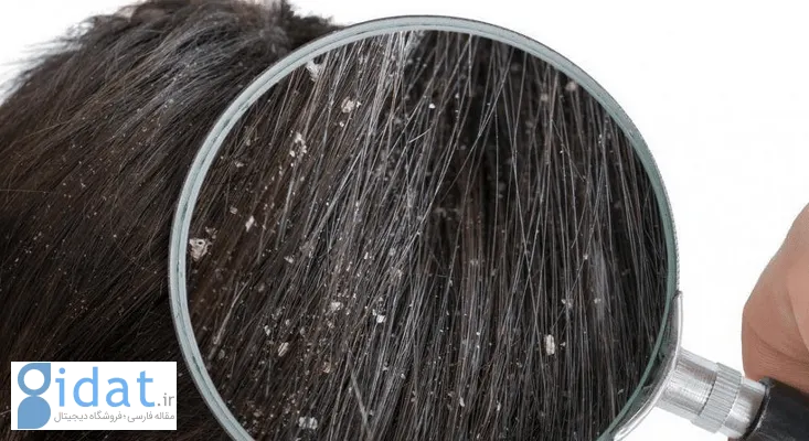 اگر شوره سر دارید، این کار ساده را شب‌ها فراموش نکنید!