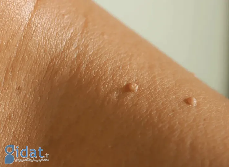 ویژگی های خال گوشتی