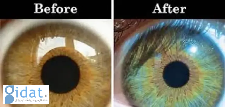 چه زمانی عمل تغییر رنگ چشم جنبه درمانی دارد؟