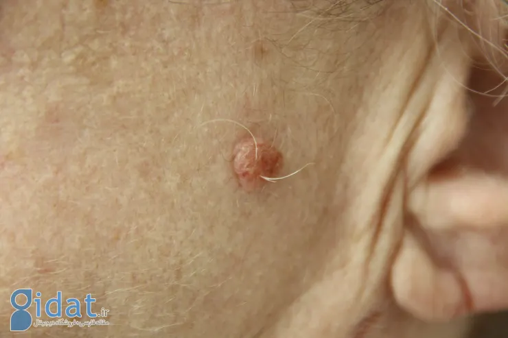 خال گوشتی چیست؟