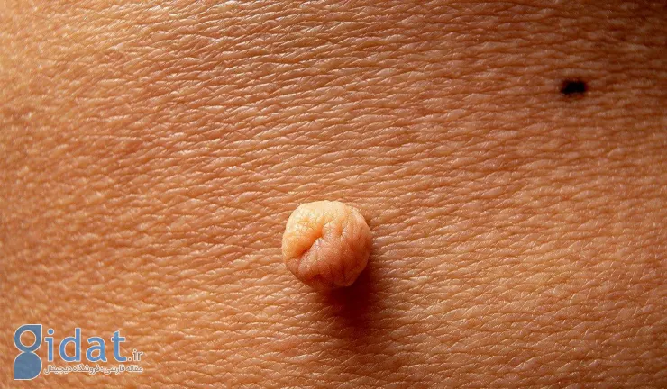 ویژگی های خال گوشتی