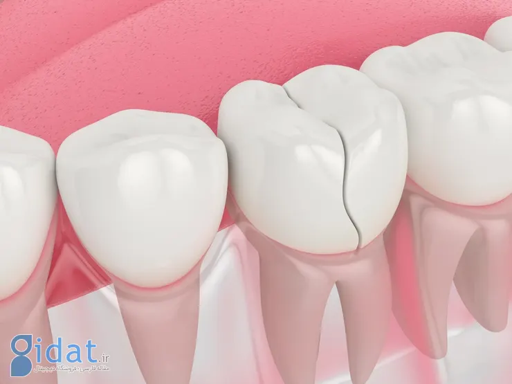 علائم و تشخیص «ترک دندان» و راه پیشگری از آن