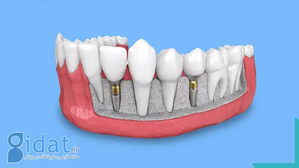 ایمپلنت دندان چیست؟ | عوارض، هزینه، مزایا، انواع و طول درمان