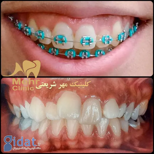 ارتودنسی یا کامپوزیت؟ کدام یک برای دندان شما بهتر است؟