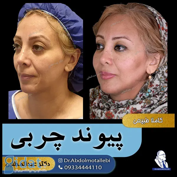 بهترین متخصص تزریق چربی صورت در تهران کیست؟